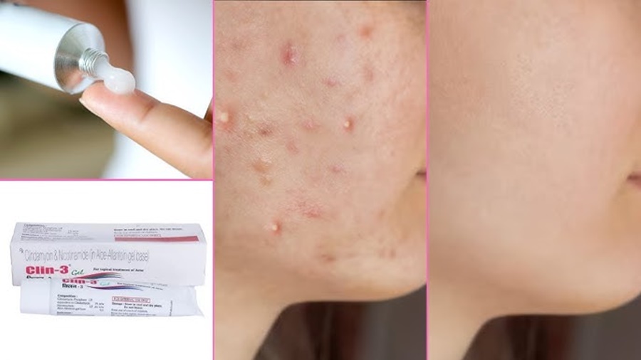 Can Face Cream Prevent Acne