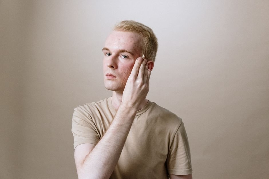 best night cream for acne prone skin