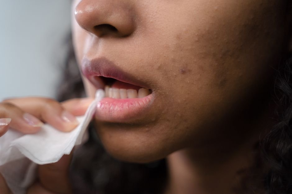 7 Best Acne Treatment for Sensitive Skin